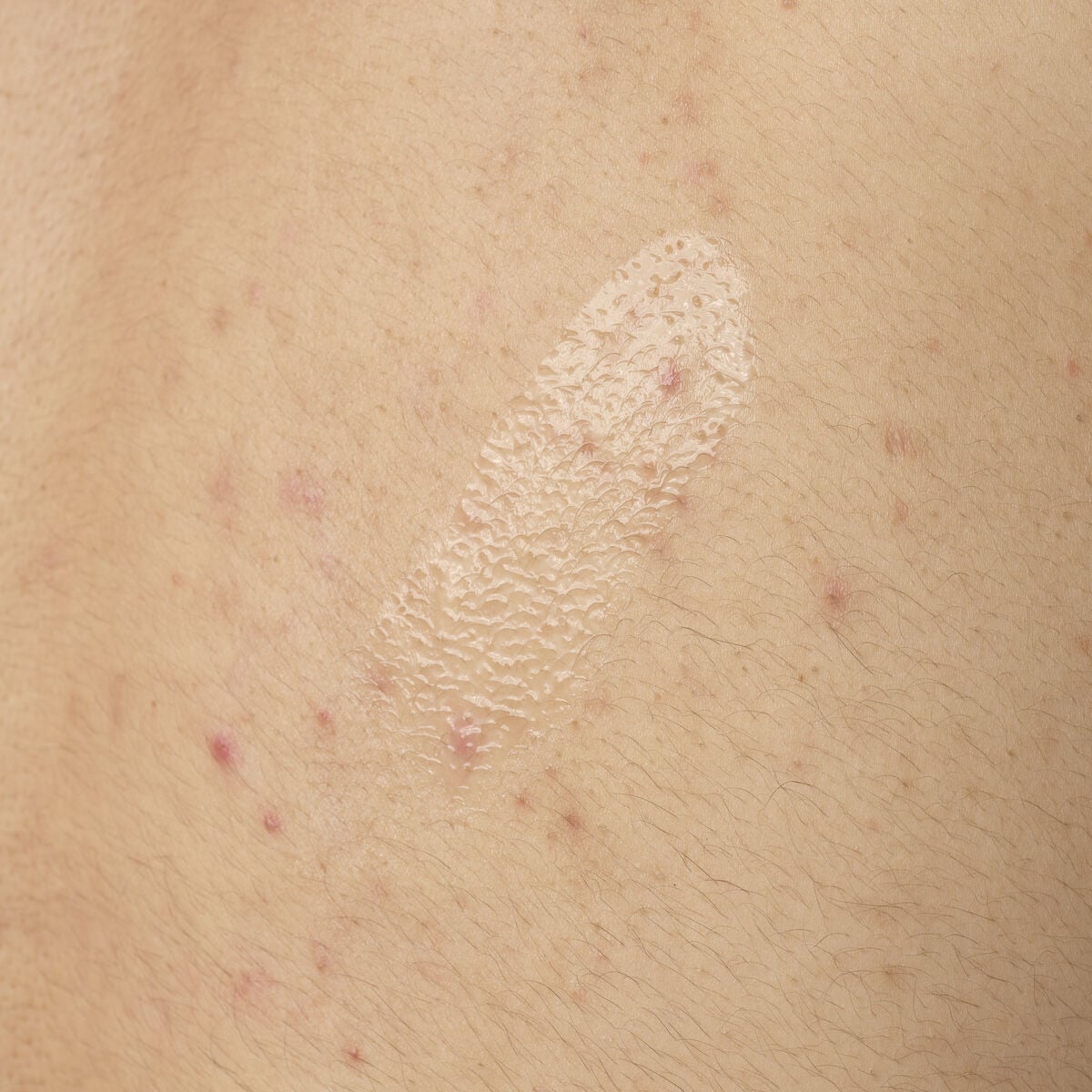 salicylic-acid-0-5-body-serum-g3 ORD-salicylic-acid-05-body-240ml-application.jpg