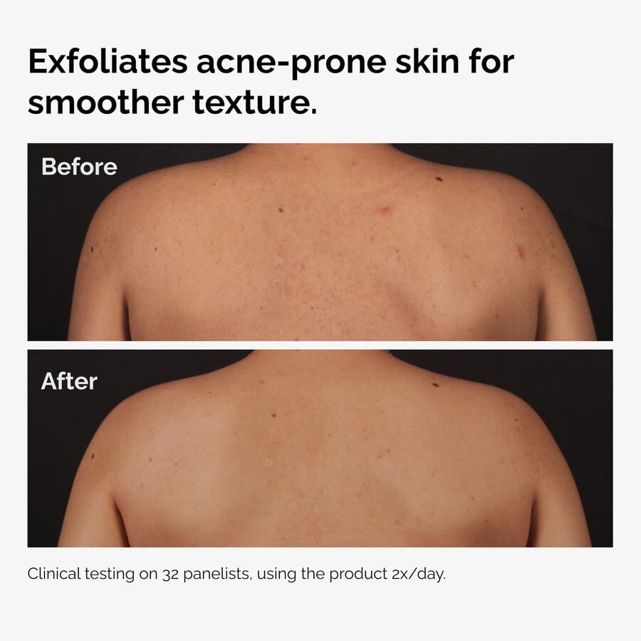 the-body-care-collection-d7 ord-salicylic-acid-body-serum-before-after-graphic-NA.jpg
